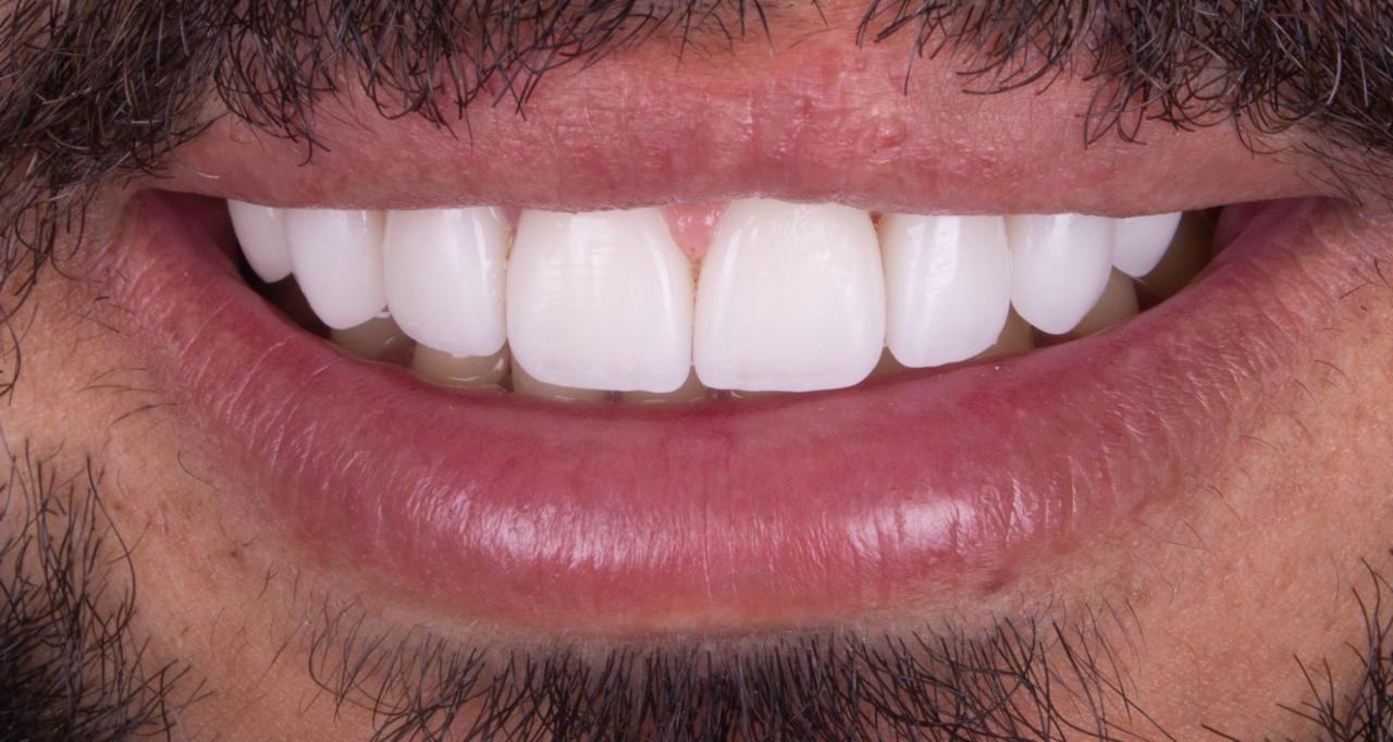 Caso 2 - Antes y Después