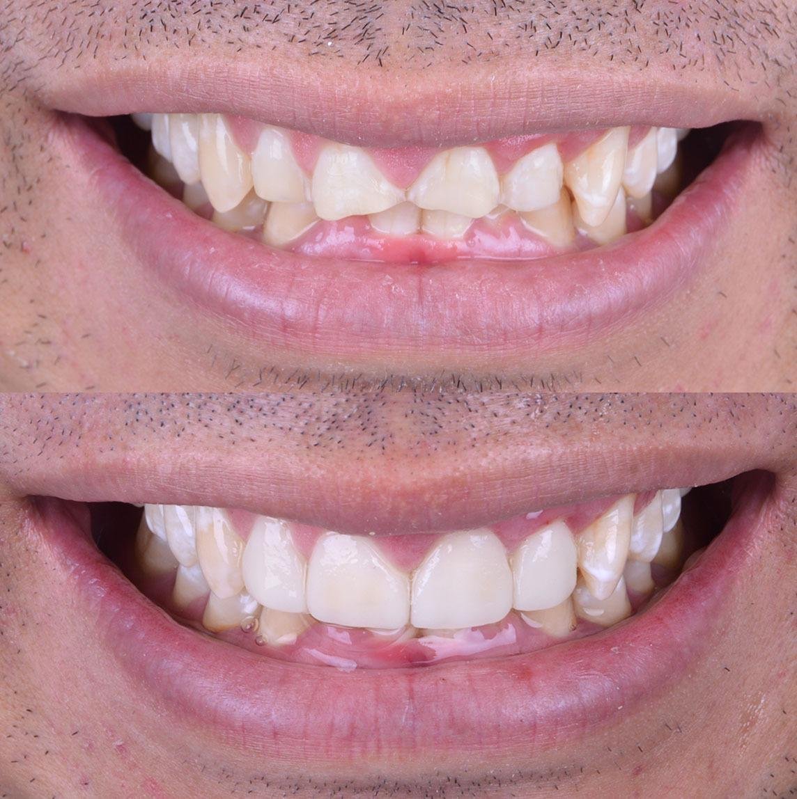 Caso 3 - Antes y Después