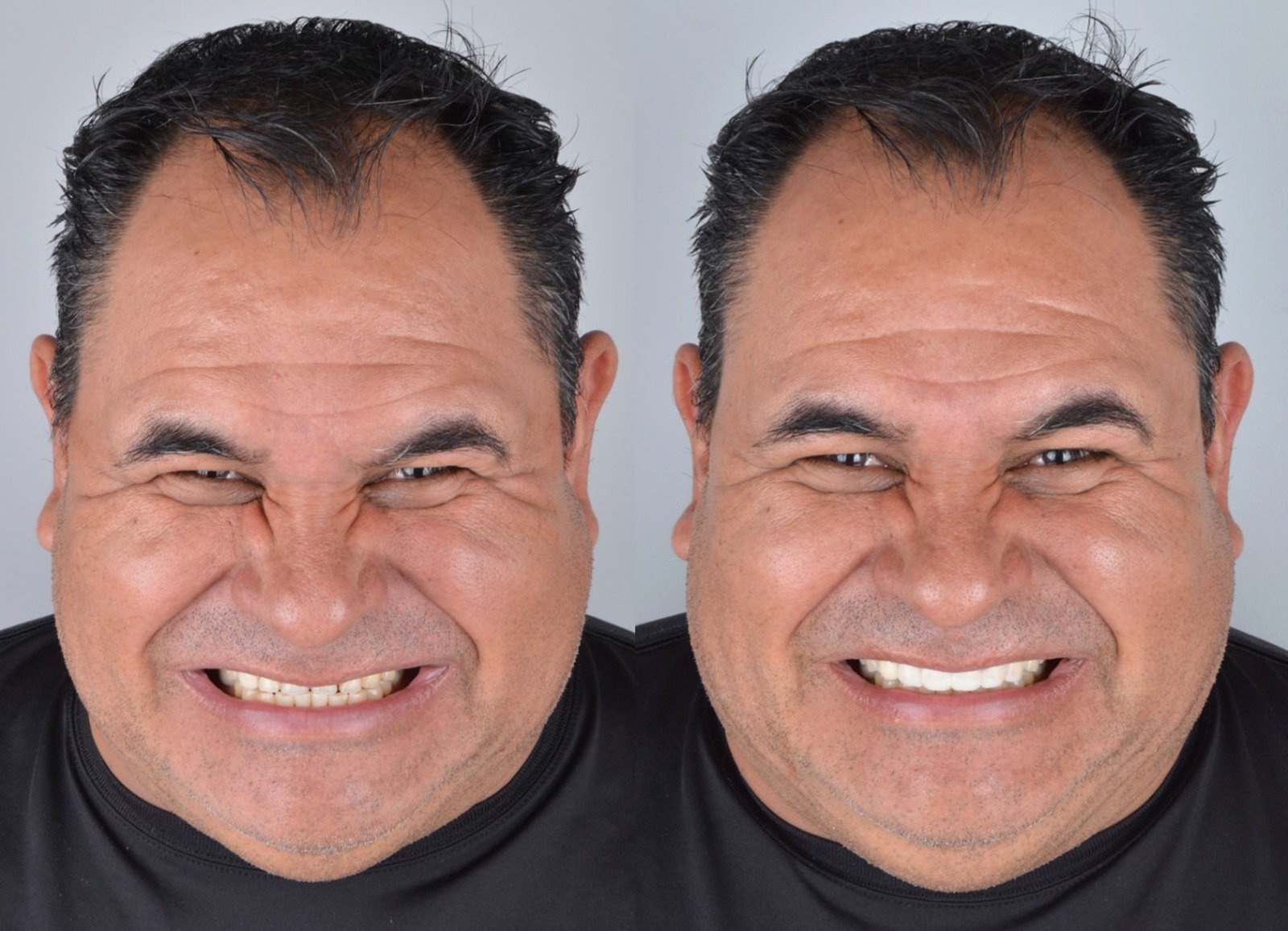 Caso 4 - Antes y Después