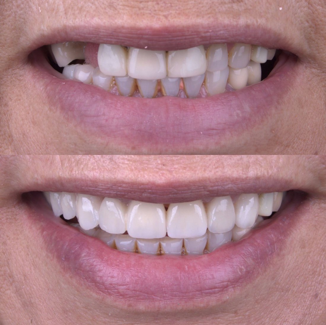 Caso 8 - Antes y Después